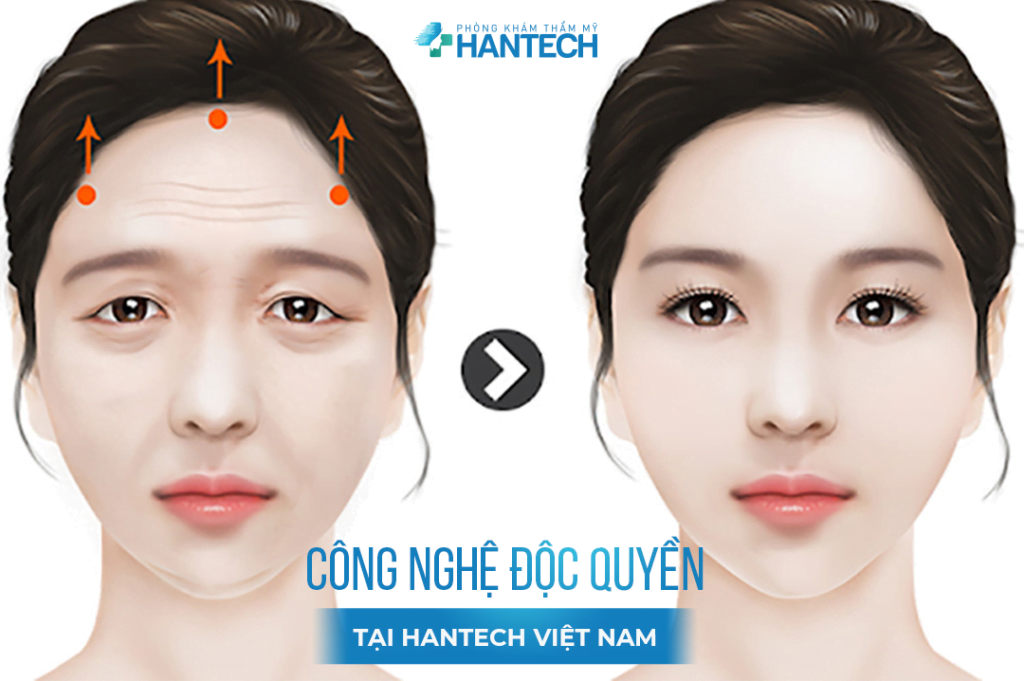 Nâng cung mày tại HanTech Việt Nam