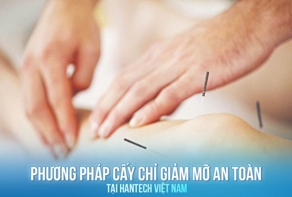 Cấy chỉ giảm mỡ tại HanTech