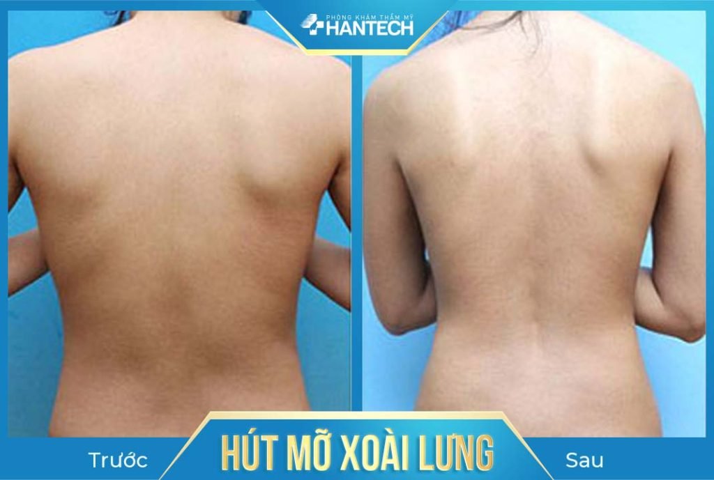 hút mỡ xoài lưng có nhiều ưu điểm vượt trội