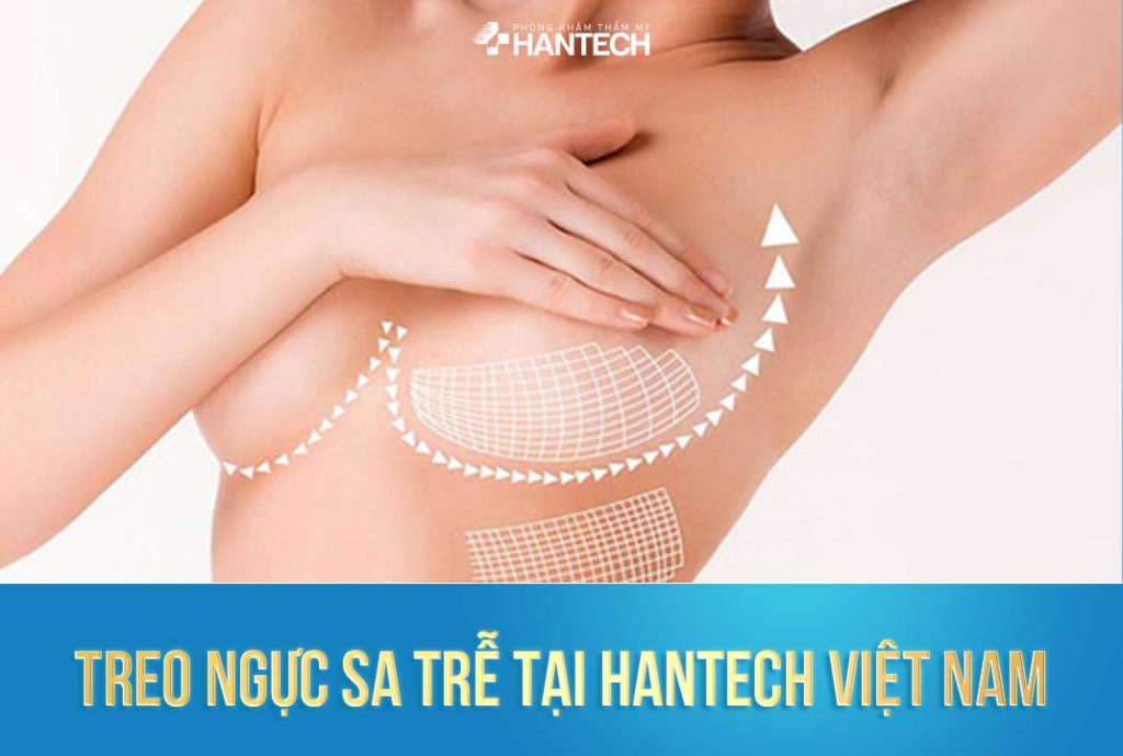 Treo ngực sa trễ tại HanTech Việt Nam